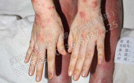 潍坊那个医院治癣良可以