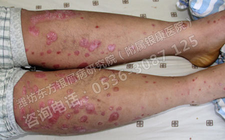 潍坊治疗银屑病效果可以的医院