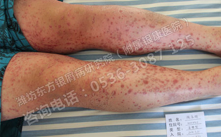 银翘病咋治能治可以