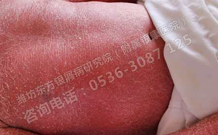 临床诊断牛皮癣的症状依据