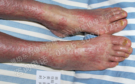 导致牛皮癣发生的根本原因是什么