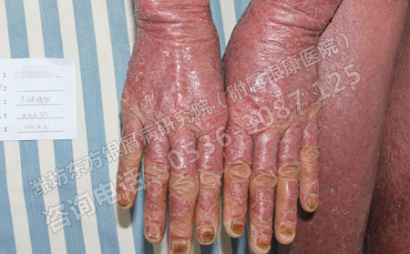 为什么牛皮癣的发病率升高了呢