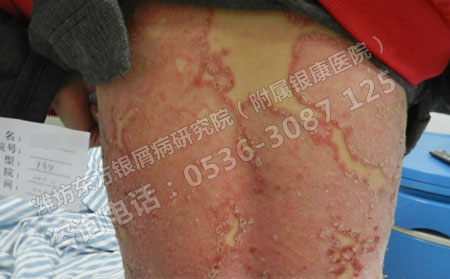 春天治疗牛皮癣效果是不是可以一些