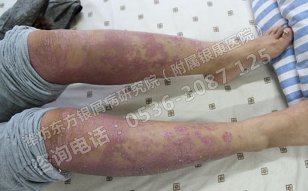 牛皮癣患者在饮食上要注意什么