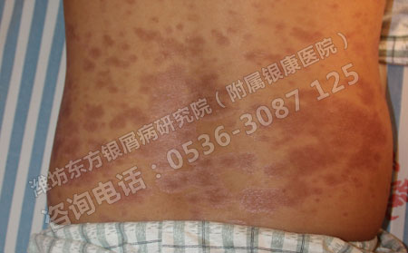 银屑病可以治可以吗