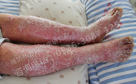 银屑病更加严重了怎么办