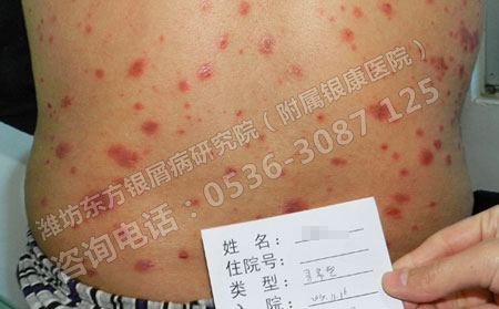 身上有小红点是点滴状牛皮癣吗,该怎么治