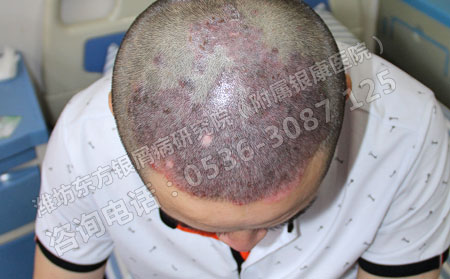 儿童患上银屑病怎么办