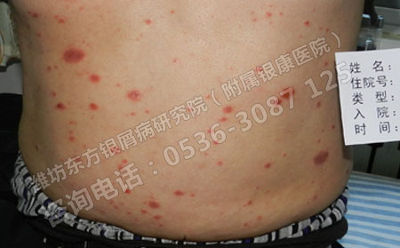 专业解答：得了银屑病之后该怎么治疗的问题