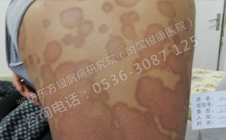 牛皮癣的发病原因到底是什么