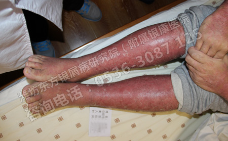 导致轻微牛皮癣恶变的四大原因?