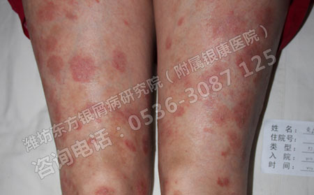 当心四大因素诱发红皮型银屑病
