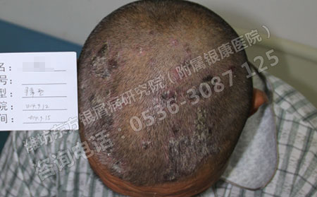 牛皮癣患者可以长时间恢复的治疗方法