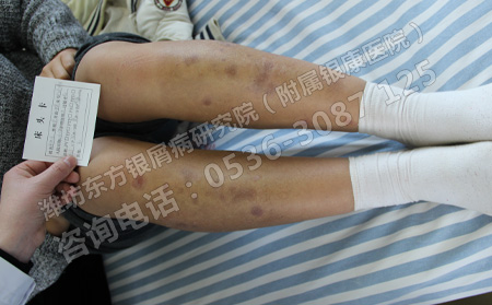 儿童银屑病治疗需要注意的关键问题