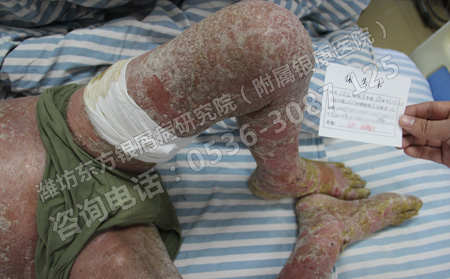 为什么有的人在夏天的时候初次发生牛皮癣