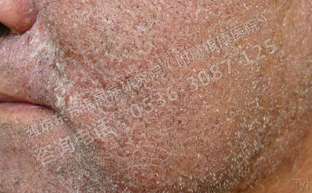 夏天得了银屑病可以不治疗吗