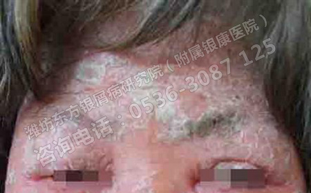 潍坊牛皮癣治疗哪家医院医生可以