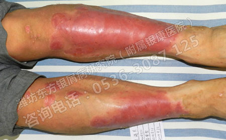 去潍坊治疗牛皮鲜