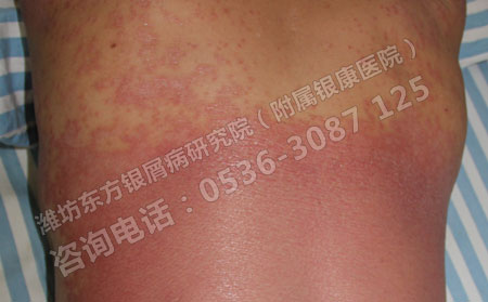 潍坊牛皮癣研究所是如何治疗牛皮癣的