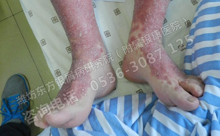 潍坊治疗牛皮癣的医院哪家费用低