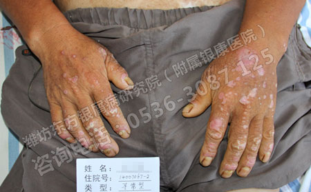 潍坊东方牛皮癣医院看牛皮癣怎么样