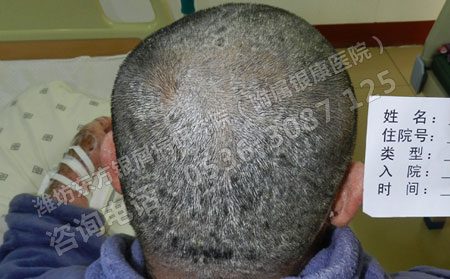 潍坊治疗牛皮癣去哪里