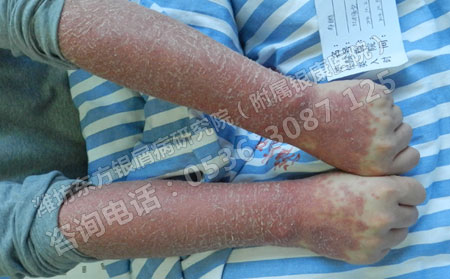 夏季治疗牛皮癣