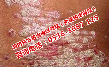 银屑病多久能治可以