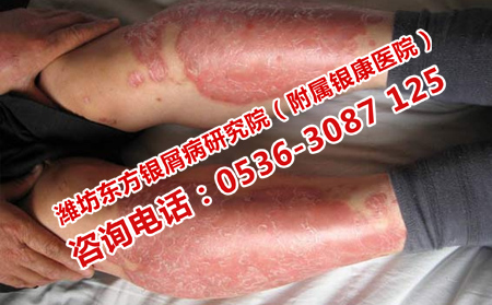 银屑病出现的原因是什么
