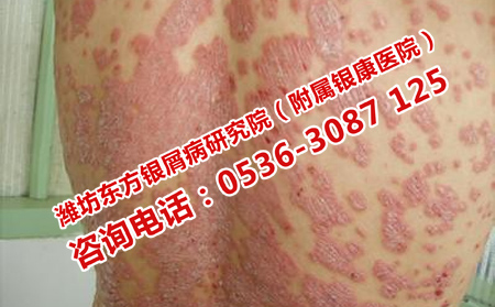 银屑病三大有效治疗方法