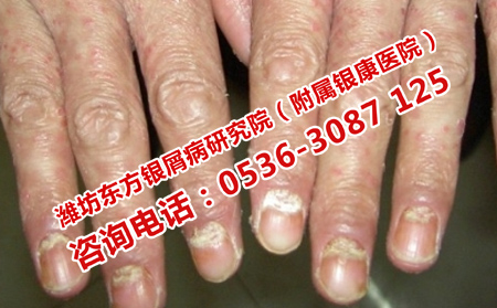 银屑病的这些危害你知道多少