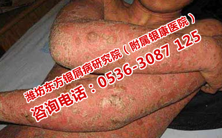 银屑病需要做哪些检查