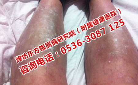 银屑病患者不能吃什么