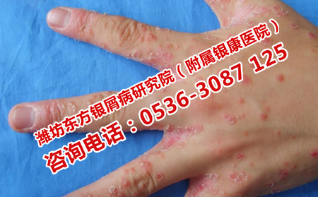 夏季、银屑病患者不可错过的治疗时机