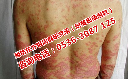 银屑病的四大诱因你知道吗