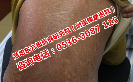 主治银屑病的医院