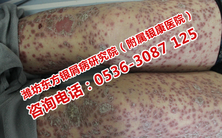 抗复发的牛皮癣医院