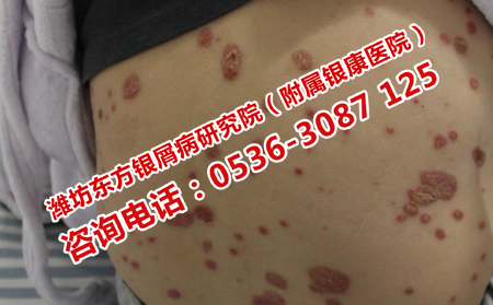 治疗银屑病复发的医院
