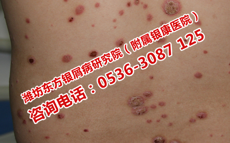 如何治疗恢复多年银屑病