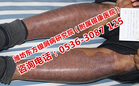 治疗孩子牛皮癣可以的医院