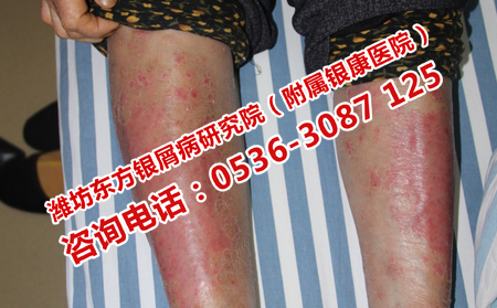 去哪里能治可以顽固的牛皮癣