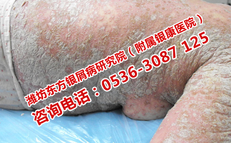 专科医院治疗牛皮癣可以吗