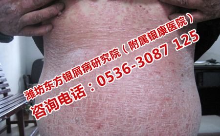 治疗牛皮癣的常识