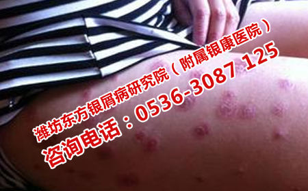 辅助治疗牛皮癣的方法