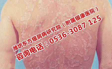 潍坊治疗牛皮癣的专业疗法