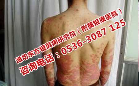 哪里治潍坊牛皮癣可以