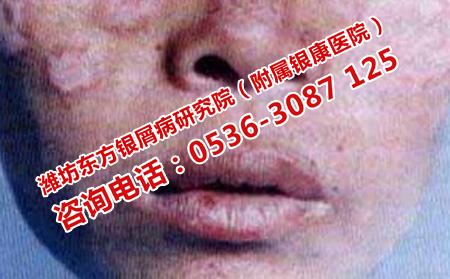 潍坊中医治牛皮癣快的医院