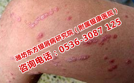 突发的牛皮癣是什么症状