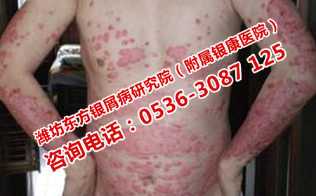 抗生素治疗牛皮癣