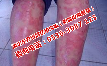 潍坊银屑病患者如何止痒